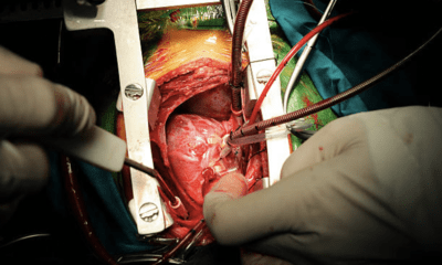 Low-Cost Heart Surgery in Bangalore