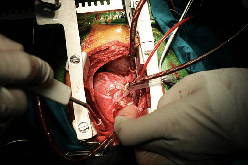 Low-Cost Heart Surgery in Bangalore