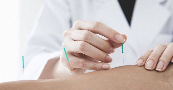 Can dry needling help with sports injuries?