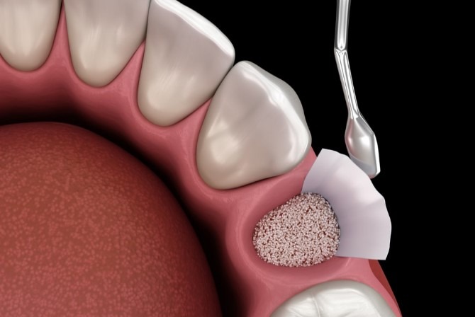 Costs and Long-Term Effects of Cadaver Bone Grafting