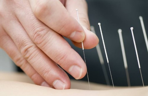 Pros and Cons of Dry Needling