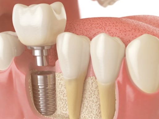 The Science Behind Cadaver Bone Grafting