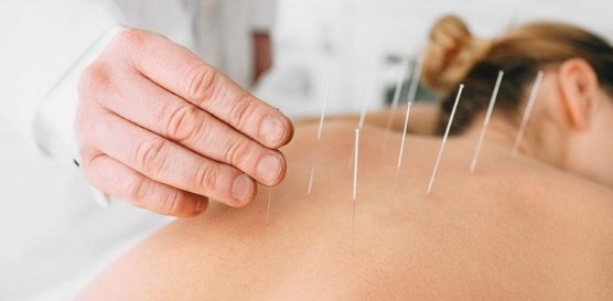What are the risks of dry needling?
